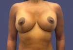 Breast Lift w/Augmentation 8 After